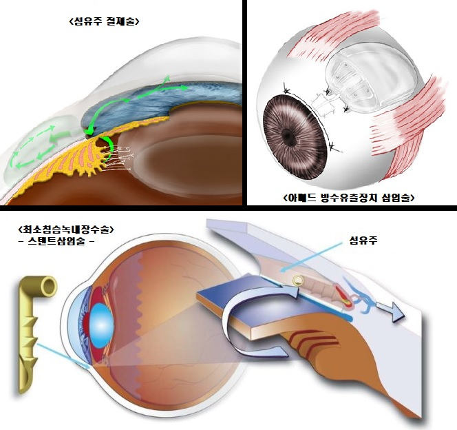 녹내장의 수술적 치료