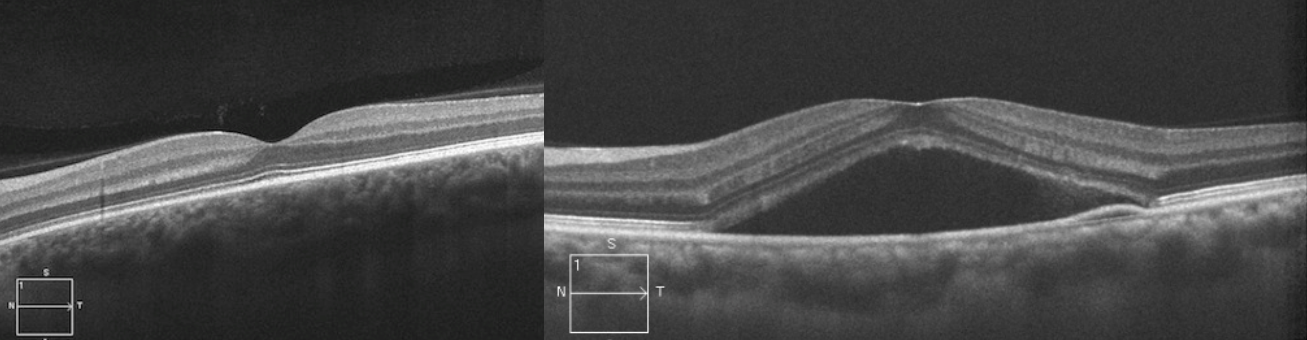 정상(좌)과 중심장액맥락망막병증(우)의 빛간섭단층촬영