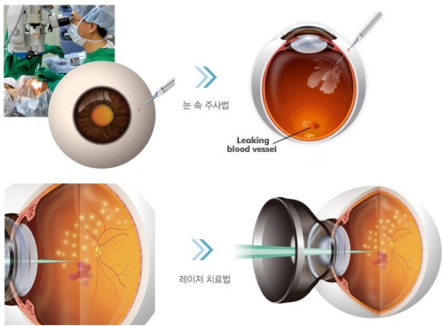 망막혈관폐쇄의 치료