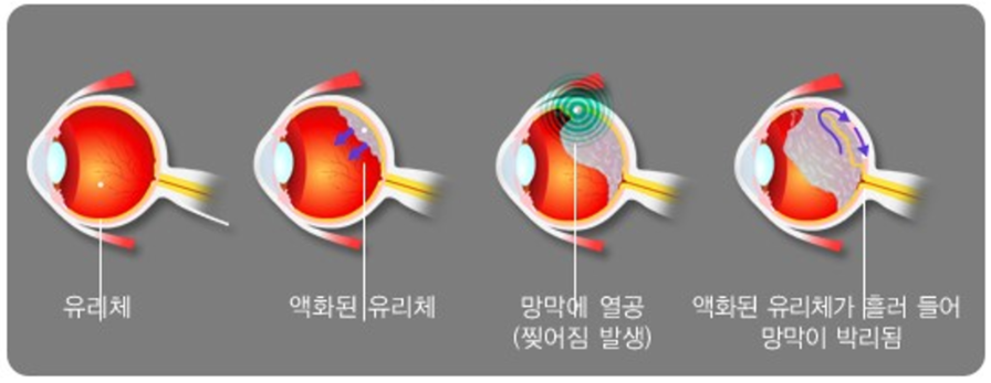 열공망막박리의 기전