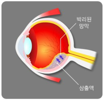 삼출망막박리의 기전