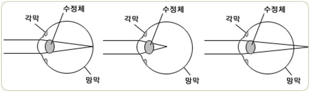 굴절이상(정상/근시/원시)